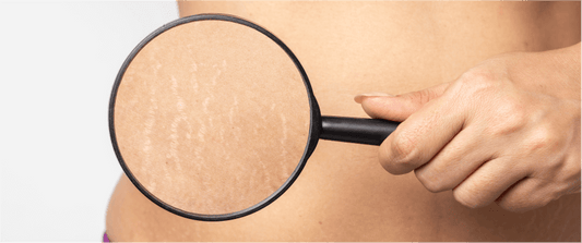 10 Natural Remedies To Remove Stretch Marks Permanently Naturally